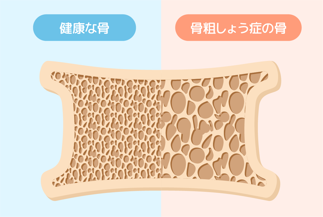 健康な骨と骨粗しょう症の骨の比較